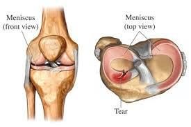 meniscus1