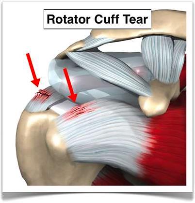 rotator cuff1