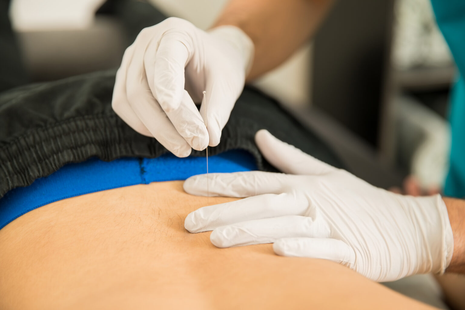 Dry Needling First Choice Physical Therapy 0233