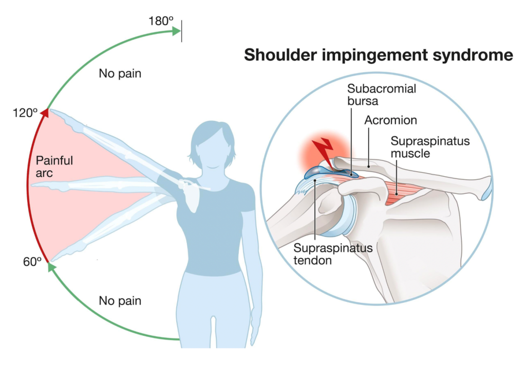 shoulder impingement syndrome diagram