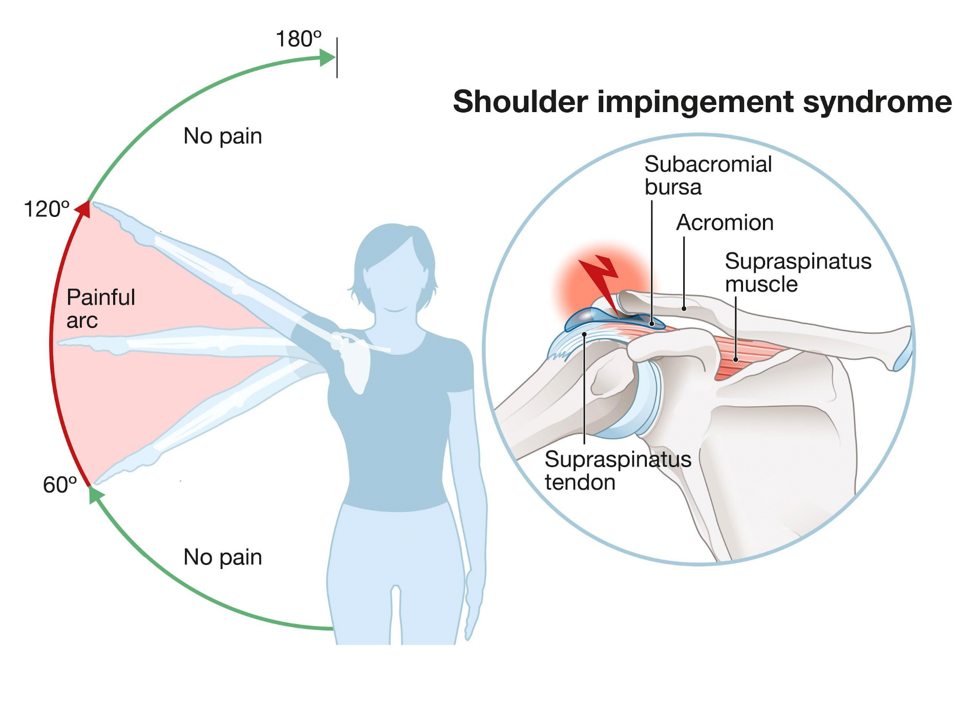 Shoulder pain? It could be subacromial impingement. - Our Chiro